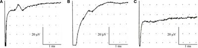 Trench Foot or Non-Freezing Cold Injury As a Painful Vaso-Neuropathy: Clinical and Skin Biopsy Assessments